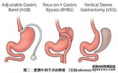 东昌府医院：胃搭桥手术治愈的2型糖尿