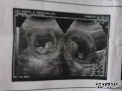 怀孕高血压是什么意思？