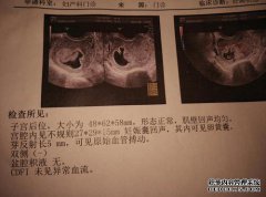 [什么是怀孕囊？]