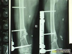 什么是不连续骨？