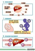 5个穴位去除脂肪肝