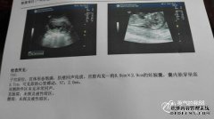 NT值范围正常吗？