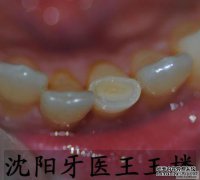 冠扩张和唇韧带切除术-射阳牙医