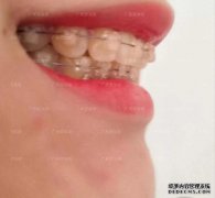哪个是更好的隐形工具或钢牙？