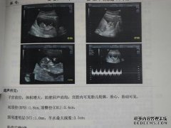 NT怀孕13周未见胎儿脚活动