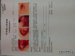 吉生五味片治疗大肠息肉的临床观察