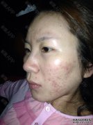如何修复粉刺