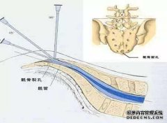 压迫脑膜囊
